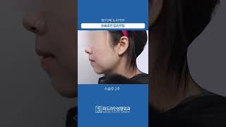 2040미드업리프팅 전후 #미드라인성형외과