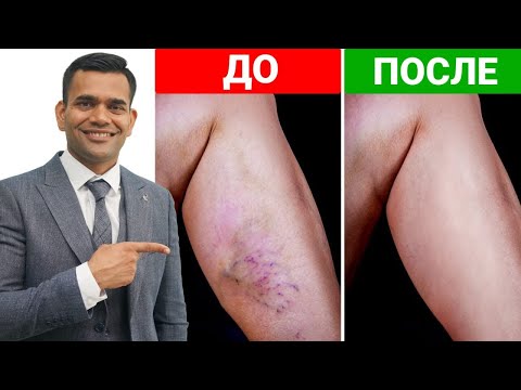 Избавьтесь От Варикозного Расширения Вен И Холодных Ног