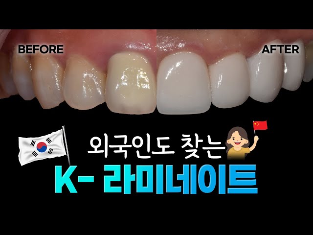 👱‍♀️외국인이 선택한 치과의 라미네이트는 어떨까❓ | 무삭제 폴리네이트