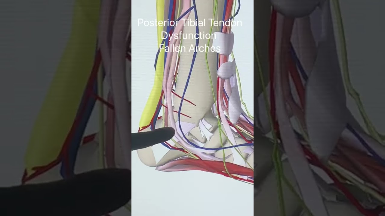 Fallen Arches, Posterior Tibial Tendon Dysfunction - YouTube Shorts
