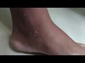 Safed Daag Vitiligo 100% Result Aaya Hai. 8867239831