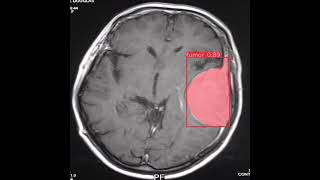 Brain Tumor Detection YoloV8|Computer Vision| Medical Imaging|Healthcare|Project|Yolo|Roboflow