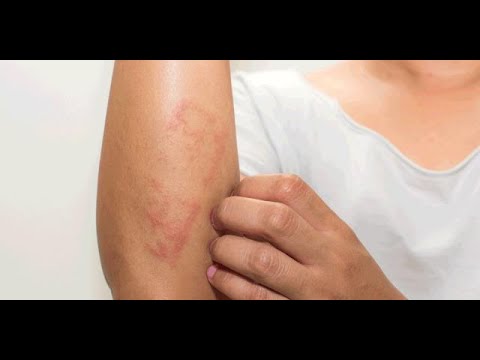 Video: Dermatite Da Radiazioni: Cause, Sintomi E 5 Metodi Di Trattamento