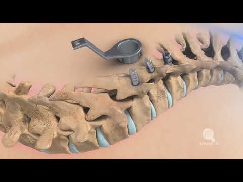 ThomasGraphic - Minimal Invasive Scoliosis Surgery Animation