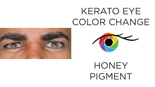 Eye Color Change from Dark to Light Brown with Kerato (Honey Pigment)