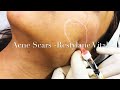 How to get Rid of Acne Scars ??? Immediate improvement can be seen in acne scars with Dermal Fillers