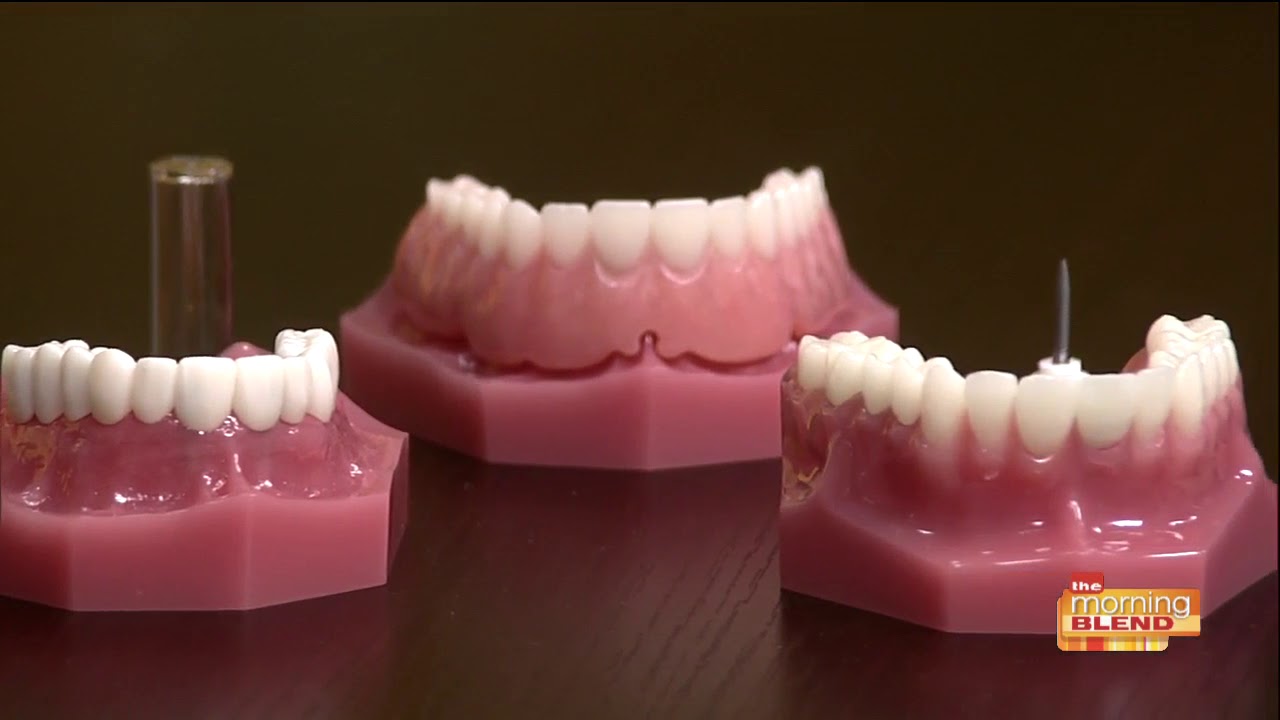 How Tucson Mini Dental Implants can change your life YouTube