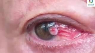 خطر الجوالات على العين