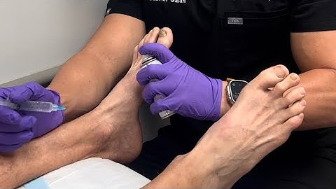 Toe-Numbing 💉: Expert Tutorial to Master the H-Block Technique for Nail Surgeries