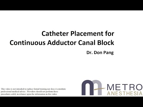 Continuous Adductor Canal Block (Catheter Placement) - Dr. Don Pang - video from Metropolitan Anesthesia