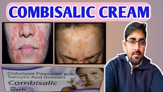 Combisalic cream | side effects | how to use | Eczema में कैसे काम करता है। Detail Review