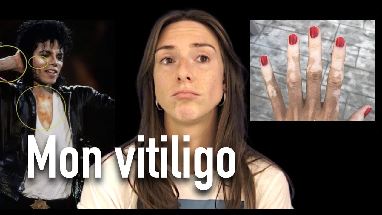 JE vous RACONTE mon VITILIGO