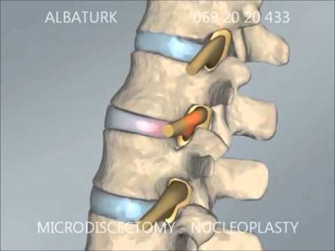 6- Kirurgji Endoskopike per Hernia Diskale Lumbare