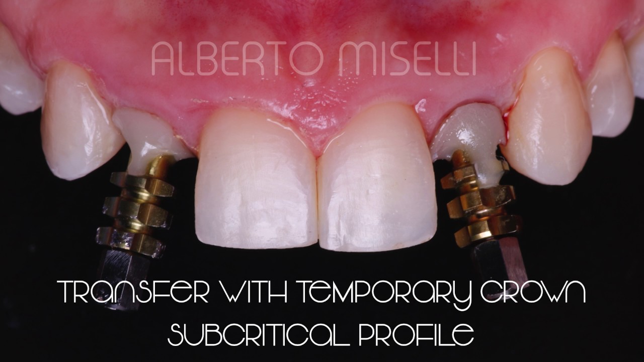 UMBRELLA CONCEPT PROTHESIC PHASE YouTube