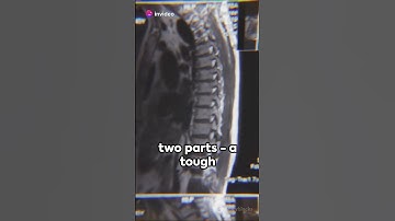 Intervertebral Discs