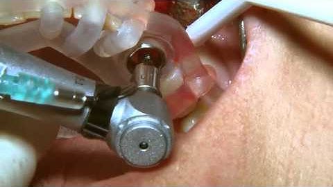 MGUIDE Live Surgical Video with Dr. Alon Schifter