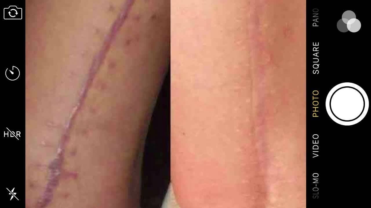 Arm Lift Scar Treatment  The Face Architect Clinic  Facebook