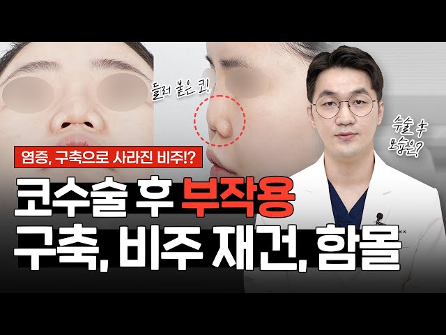 코 구축으로 사라진 비주!?｜염증으로 들러붙은 코끝, 함몰, 좁아진 콧구멍｜3번째 코재수술, 피부이식, 자가늑연골 재건 사례