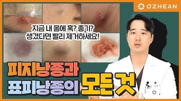 시한폭탄! 피지낭종과 표피낭종 그냥 두면 염증이나 고름이 될 수 있다고?  (Epidermal cyst, Steatocystoma)