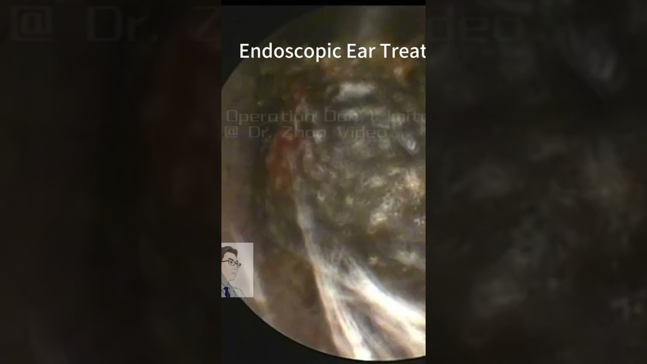 ASMR - Ear cleaning - lots of ear wax (video 75) link full video:    Link full video:   * This procedure is carried out by Toc Nam Ha  Tinh. *