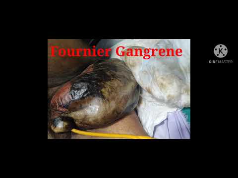 FOURNIER GANGRENE ।।GANGRENOUS PENIS ।। SCROTAL GANGRENE ।। DEBRIDEMENT ।।
