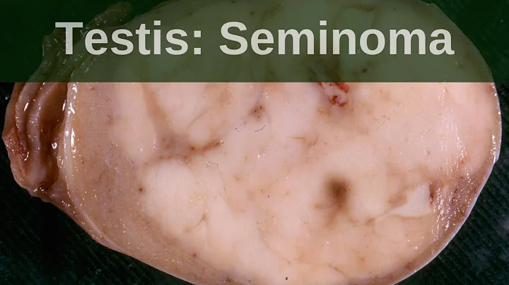 Testicular germ cell tumours  -  Seminoma - Pathology mini tutorial - DayDayNews