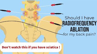Spine surgeon: When radiofrequency ablation is the right treatment for your low back pain.
