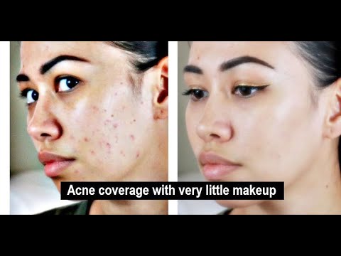 Covering acne without piling makeup on | pimples, scars, dark spots, and other blemishes