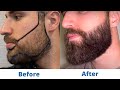 Greffe de barbe de leon avant et aprs  rsultats mois par mois l elithair