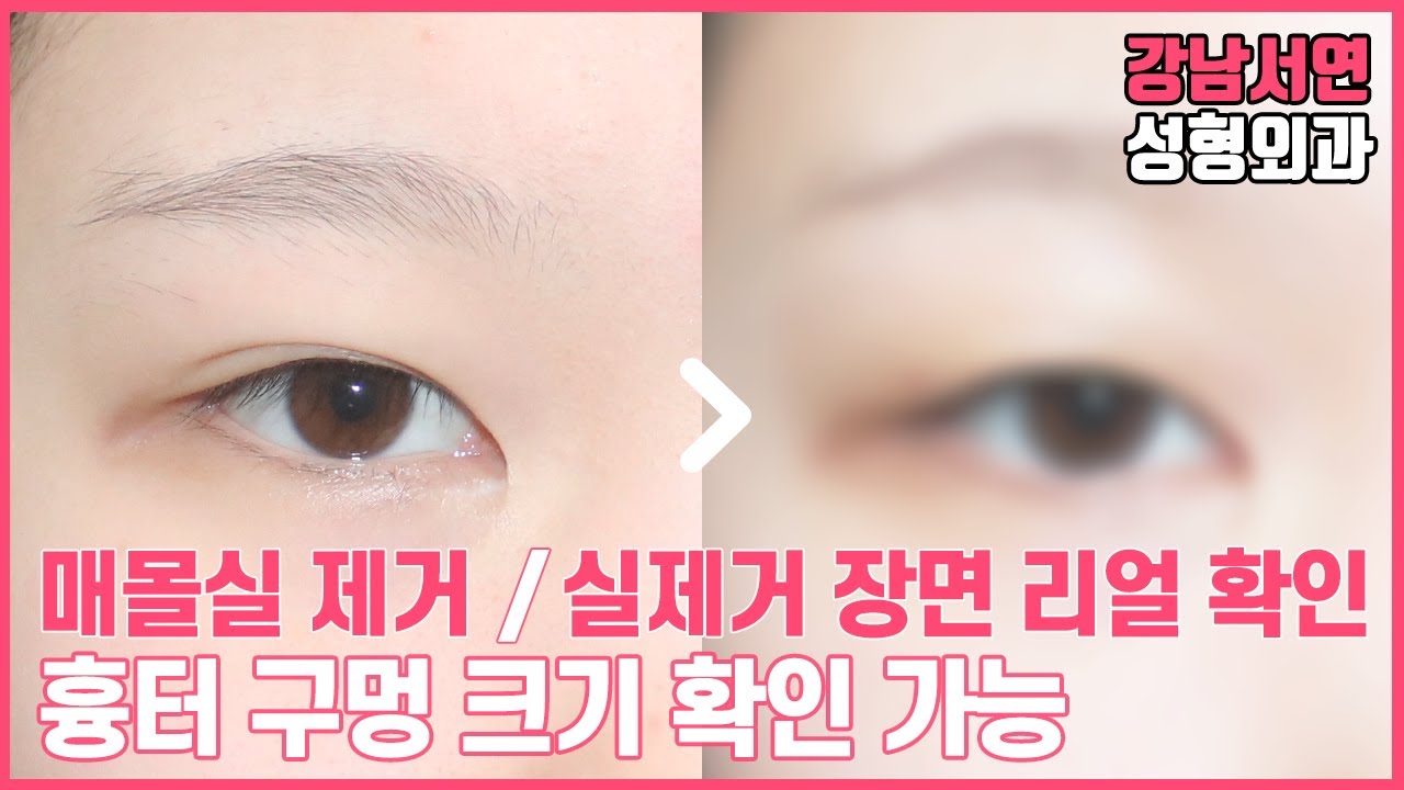 [Ганнам Соён гоо сайхны мэс заслын эмнэлэг] Суулгасан утсыг авах, утсыг авч байгааг бодитоор харах, сорвины нүхний хэмжээг шалгах боломжтой.