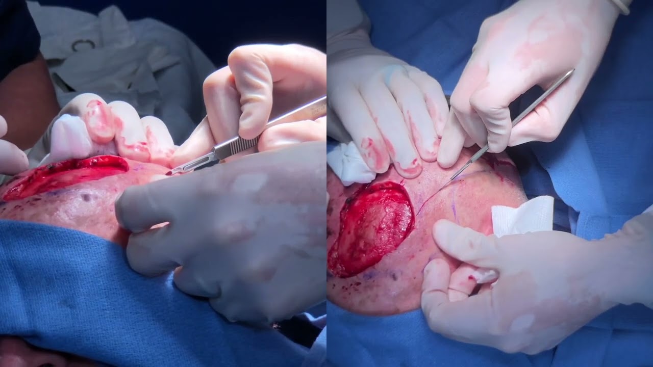 Temporoparietal fascial sling island pedicle flap (Sling-STA)