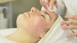 Acne Analysis And Treatment Part 1
