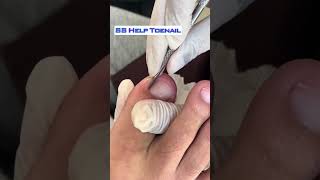 Extreme Toenail Trimming Transformation 6