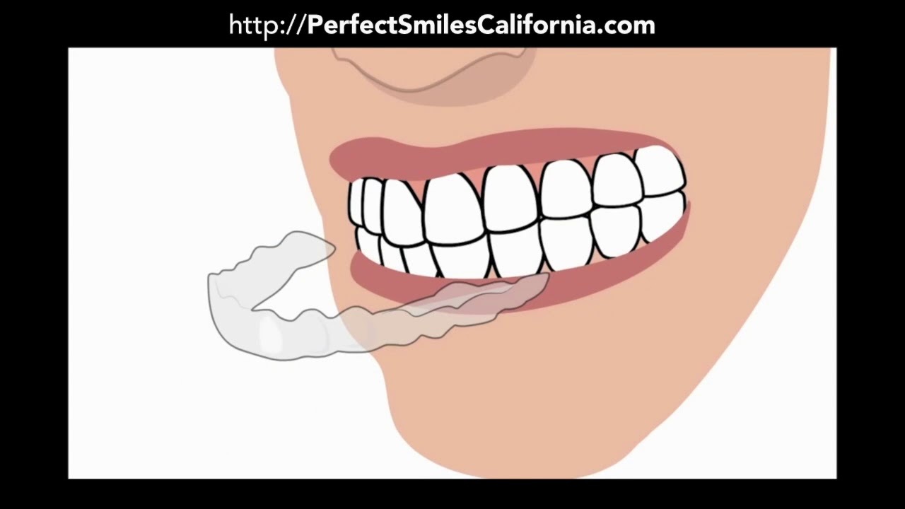 Chula Vista CA: Invisalign Dental Braces Dentist Chula Vista