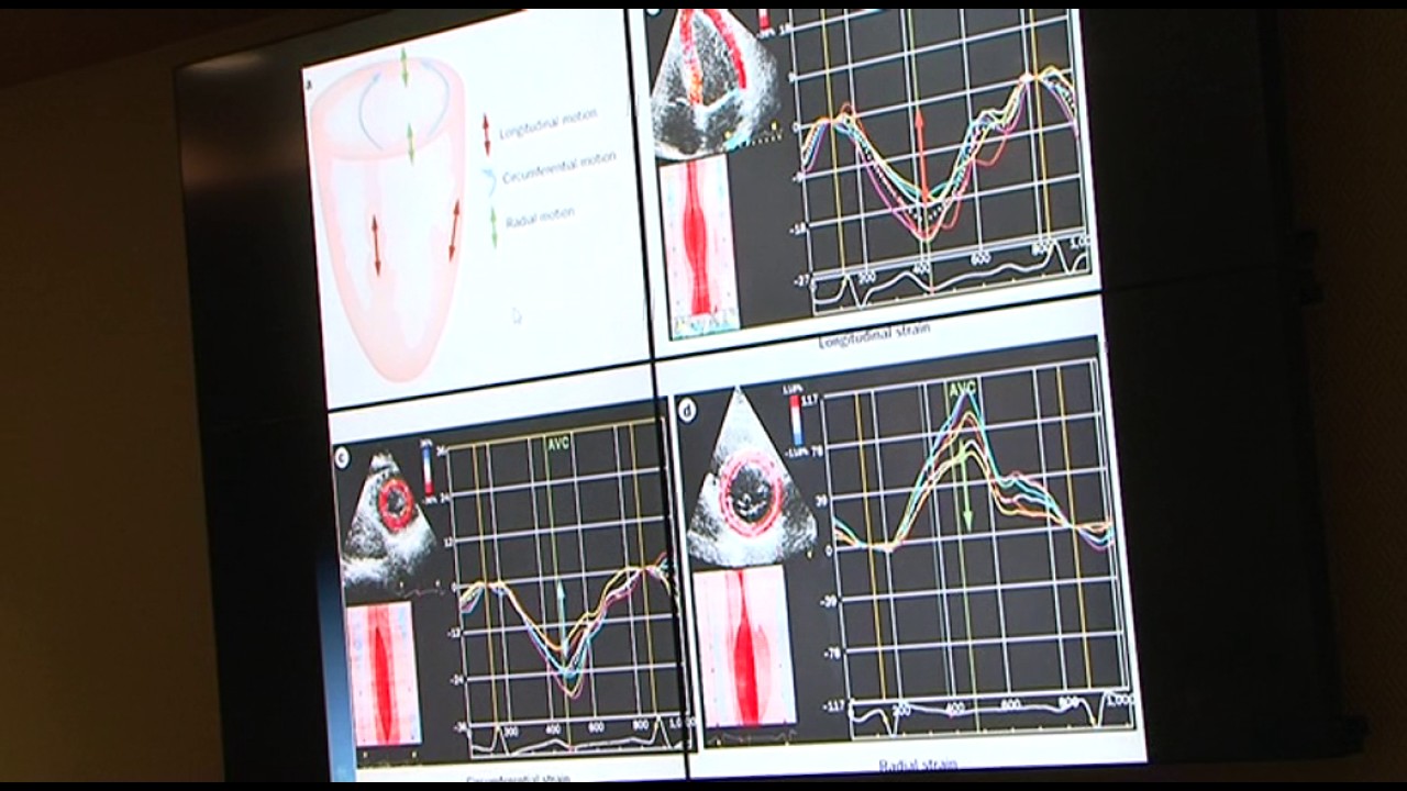 Basic principles of speckle tracking