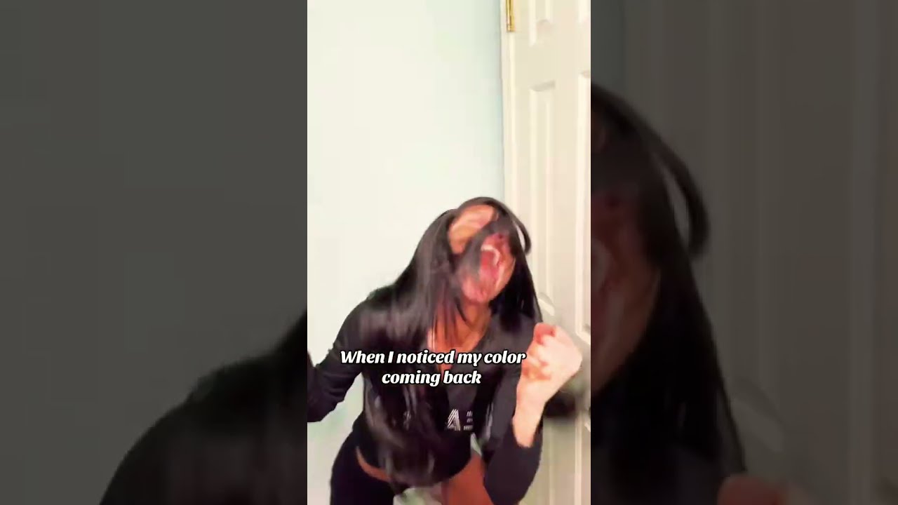 Not Really I Actually Didn T Even Notice Explore Vitiligo Itsajoke