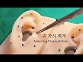 [ASMR] 귀에서 자란 딱딱한 가시 제거하기｜Removing Thorns of Ears｜Visual Triggers