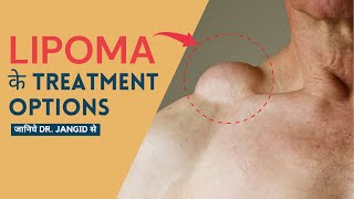 Treatment Options for Lipoma | Lipoma Surgery in Delhi | Lipoma Treatment in Delhi | SkinQure