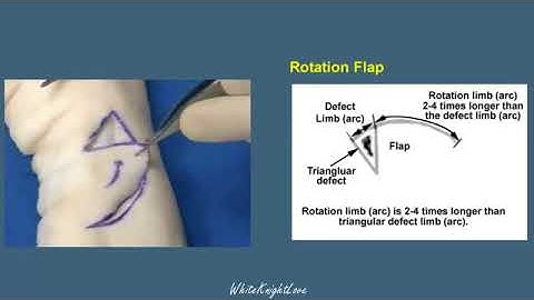 8 3 Rotation Flap  Skin Flaps   Essential Surgical Skills WhiteKnightLove