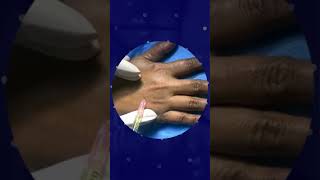 Hand Rejuvenation using PRF Therapy at Lisa Aesthetic Centre by Dr Jenny Mathew