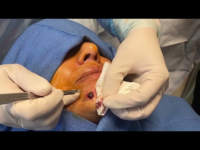 Dallas Mole Removal Video