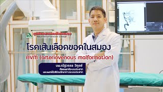 รู้จักภาวะ AVM โรคหลอดเลือดสมองผิดปกติ  Cerebral arteriovenous malformation