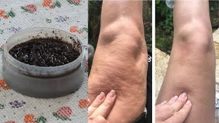 Comment se débarrasser de la cellulite Naturellement de la cellulite. vergetures