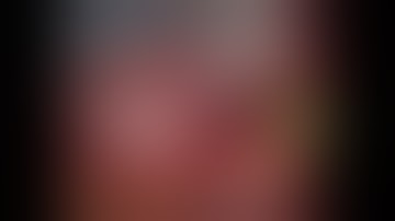 ROBOTIC CHOLECYSTECTOMY with ICG