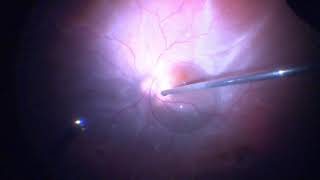 Surgery: Vitrectomy for Retinal Detachment: Assortment of Cases