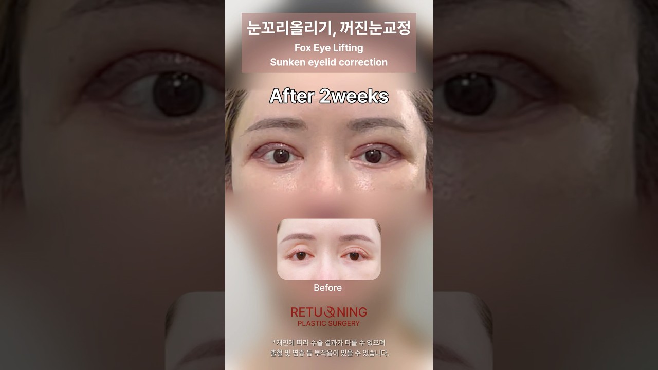 "여우눈성형 진짜 🦊여우처럼 될까? 전후 비교 충격!"
