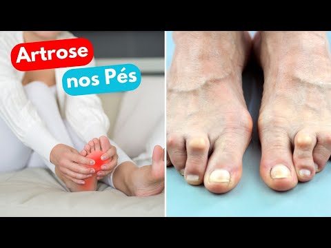 Vídeo: Deformação Dos Dedos Dos Pés - Causas, Sintomas, Diagnóstico, Tratamento