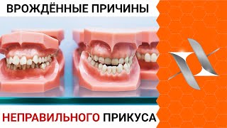 MALOCCLUSION | Congenital causes of orthodontic abnormalities.