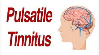 Pulsatile Tinnitus: 7 Different Anatomic Causes of Hearing Pulsations in the Ear