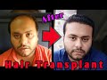 Hair Transplant Result || Best Hair Transplant In India || Hair Transplant 10 Months Result